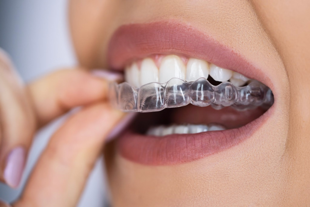 Close up of a woman with lavender nails inserting her clear Essix retainer