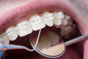 Clear braces for discreet teeth straightening