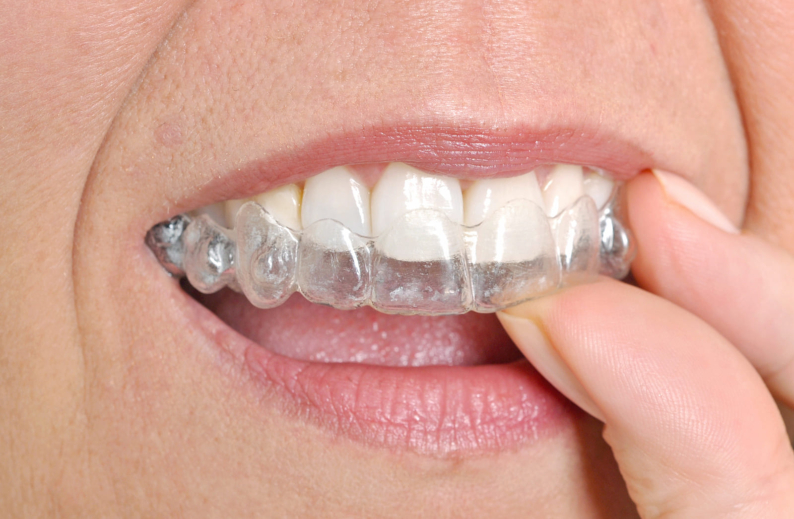 Invisalign treatment journey in Parkville